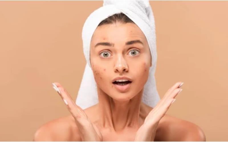 Review of New York Skin Solutions Acne Facial Effective Acne Remedy or Not